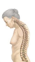 Kyphosis (dowager's hump) in osteoporosis