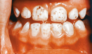 Dental fluorosis due to excess fluoride