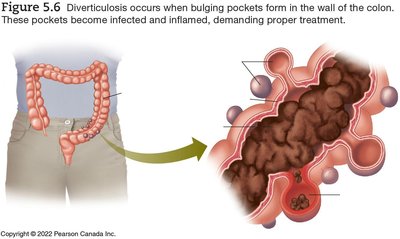 Diverticulosis in the colon