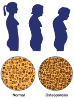 Osteoporosis in vertebrae and bone structure