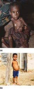 Marasmus and Kwashiorkor: protein deficiency disorders