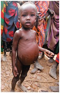 Child with kwashiorkor (edema and swollen belly)