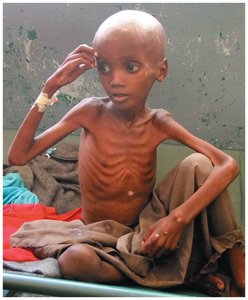 Child with marasmus (severe wasting)