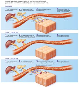 Normal, Type 1, and Type 2 diabetes mechanisms