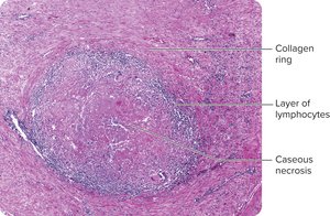 Histological section of a tubercle showing collagen ring, lymphocytes, and caseous necrosis