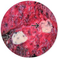 Gross pathology of lung showing tuberculous lesions (caseous necrosis)