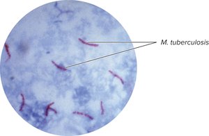Acid-fast stained Mycobacterium tuberculosis under microscope
