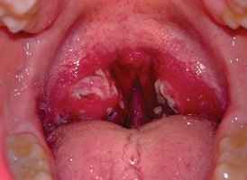 Clinical image of pharyngitis showing inflamed throat and exudate