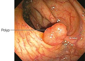 Colon polyp