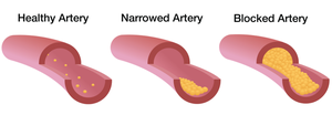 Diagram of healthy, narrowed, and blocked arteries