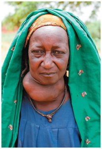 Goiter due to iodine deficiency