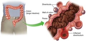 Diverticulosis and diverticulitis in the colon