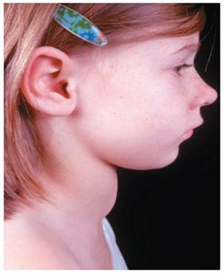 Goiter due to iodine deficiency