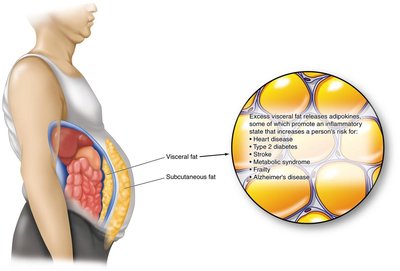 Visceral vs. subcutaneous fat and associated risks