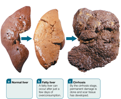 Stages of alcoholic liver disease: normal, fatty liver, cirrhosis