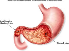 Diagram of stomach showing ulcer location