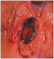 Endoscopic image of a stomach ulcer