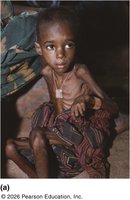 Marasmus: severe protein-energy malnutrition
