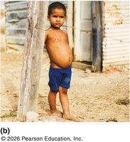 Kwashiorkor: severe protein deficiency with edema