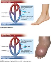 Normal and abnormal fluid balance due to protein levels