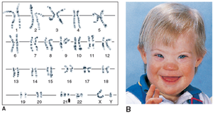 Karyotype and clinical features of Down syndrome