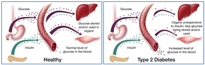 Healthy vs. Type 2 Diabetes glucose metabolism