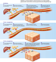 Type 1 diabetes mechanism