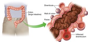 Fiber reduces risk of diverticulosis