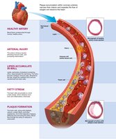 Atherosclerosis: plaque formation in arteries