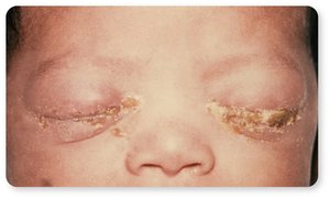 Photograph of neonatal gonococcal eye infection