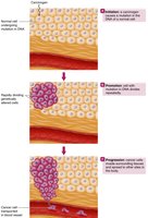 Stages of cancer development: initiation, promotion, progression