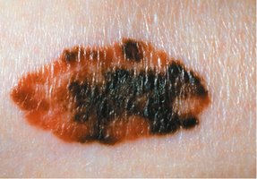 Lesion associated with malignant melanoma