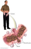 Diverticulosis and diverticulitis in the colon