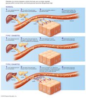 Diabetes mechanism and types