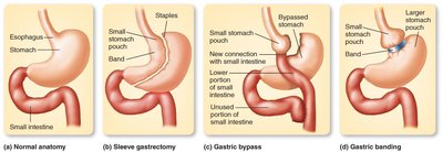 Bariatric surgery procedures