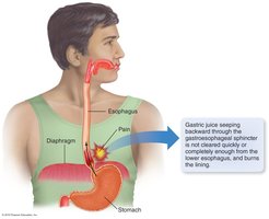 Heartburn: gastric juice reflux