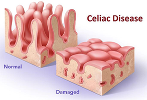 Celiac disease: normal vs damaged villi