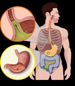 GERD and peptic ulcer illustration