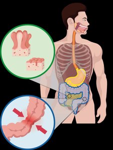Celiac disease and intestinal villi