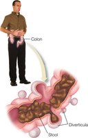 Diverticulosis and stool in the colon