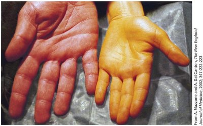 Hypercarotenemia (orange skin from excess beta-carotene)