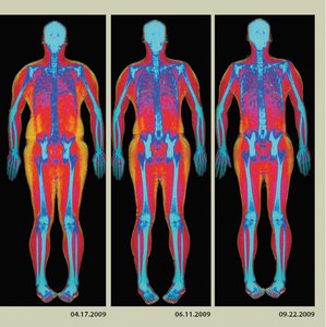 DEXA scan results