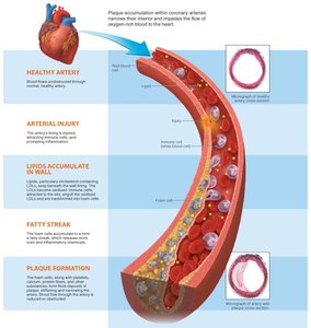 Plaque accumulation in arteries