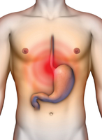 Heartburn sensation in GERD