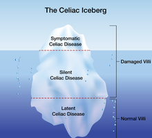 Celiac disease iceberg model