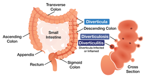 Diverticulitis in the colon