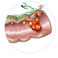 Stages of colon cancer