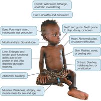 Effects of undernutrition on a child