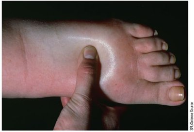 Edema due to loss of plasma proteins