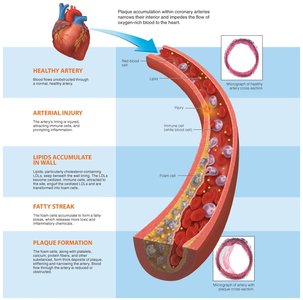 Stages of plaque formation in coronary arteries